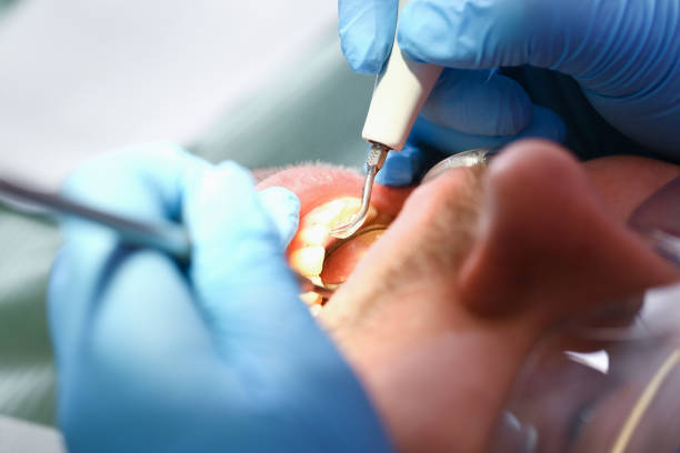 Best Emergency Dentist for Lost Fillings or Crowns in Ukiah, CA